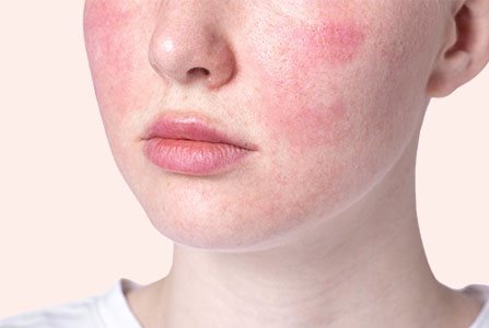 Pele facial afetada pela rosácea