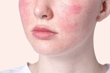 Pele facial afetada pela rosácea