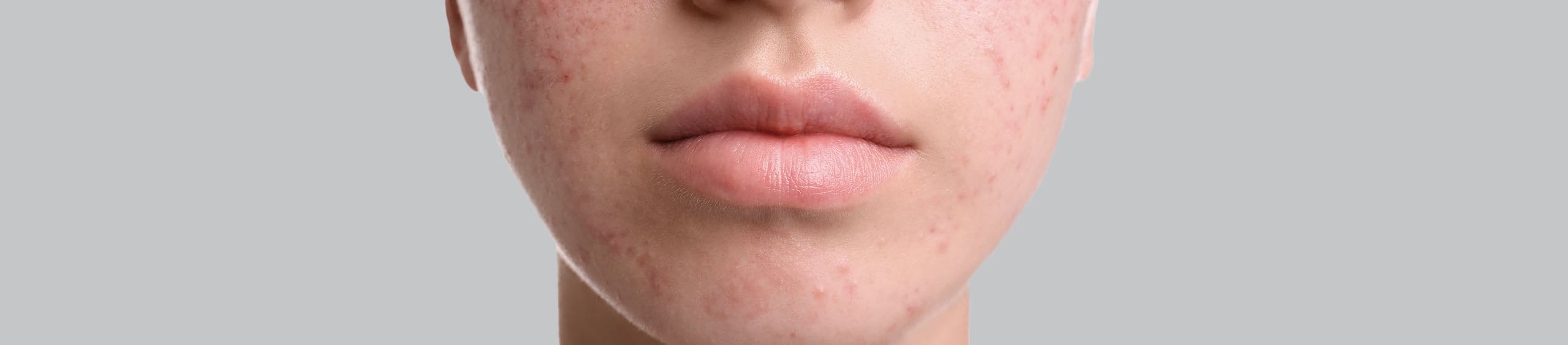 Acne Hormonal