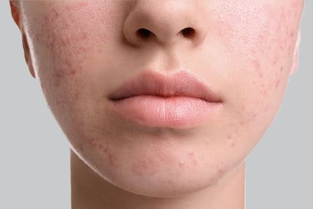 Acne Hormonal