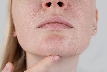 pele ressecada no rosto