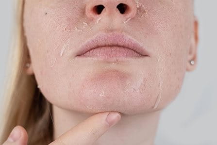 pele ressecada no rosto