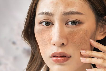 Hiperpigmentação causada pelo melasma