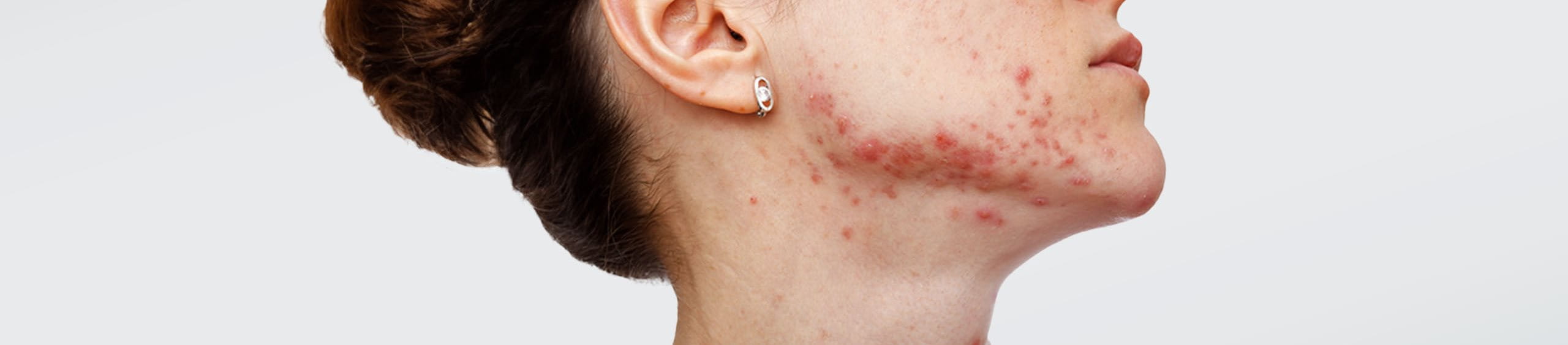 características del acné por estrés