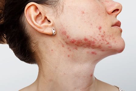 ¿Imperfecciones causadas por estrés?