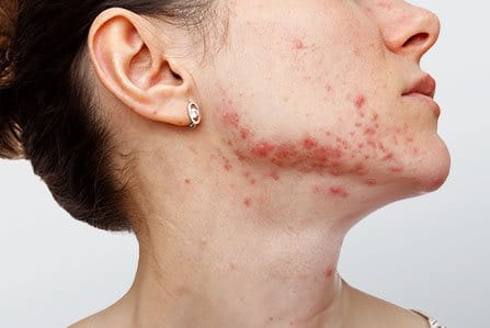 ¿Imperfecciones causadas por estrés?