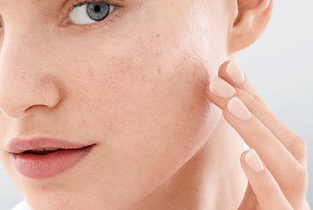 Piel grasosa causada por medicamentos