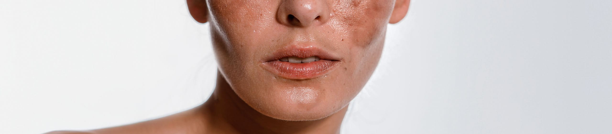 causas de las manchas por melasma