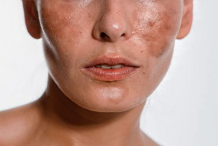 Causas de manchas por melasma