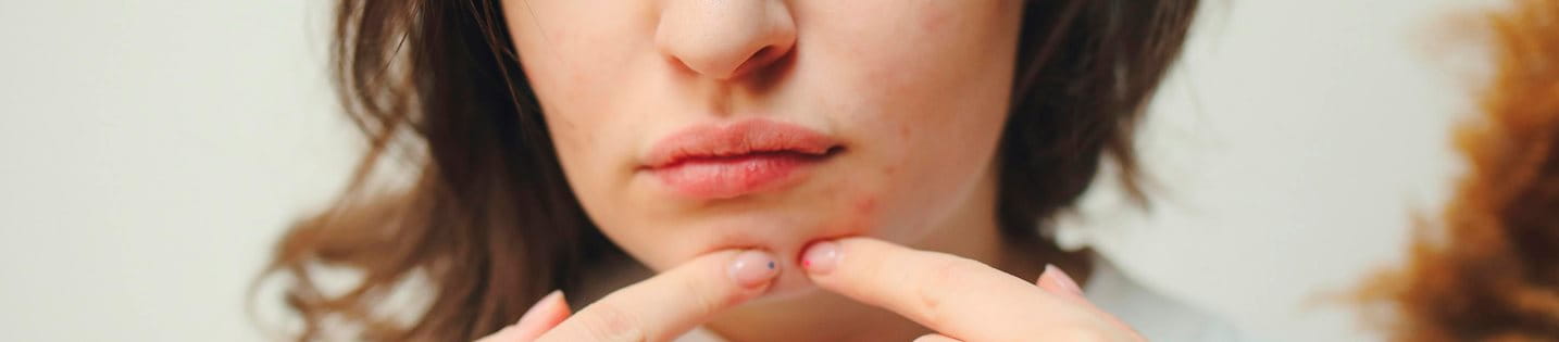 En la formación de los puntos negros, de las espinillas y de los granos intervienen muchos factores complejos