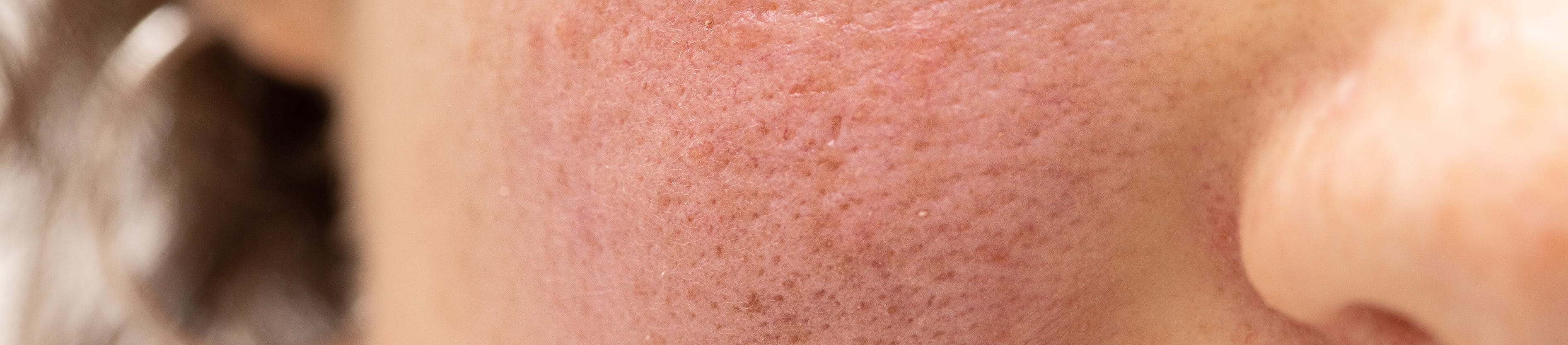 Marcas Rojas Manchas rojas en la piel: causas y remedios | Eucerin