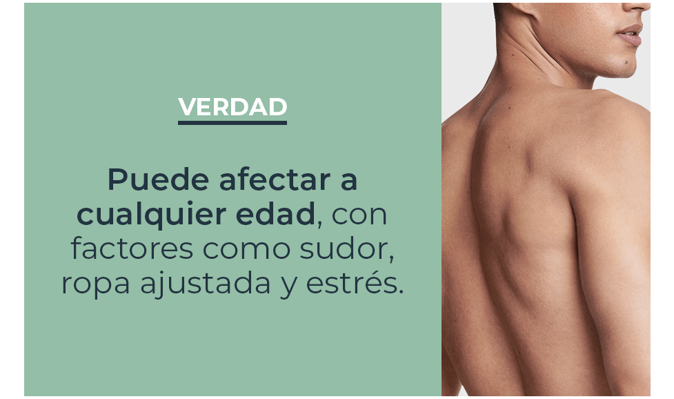 Mitos y verdades sobre acné en la espalda