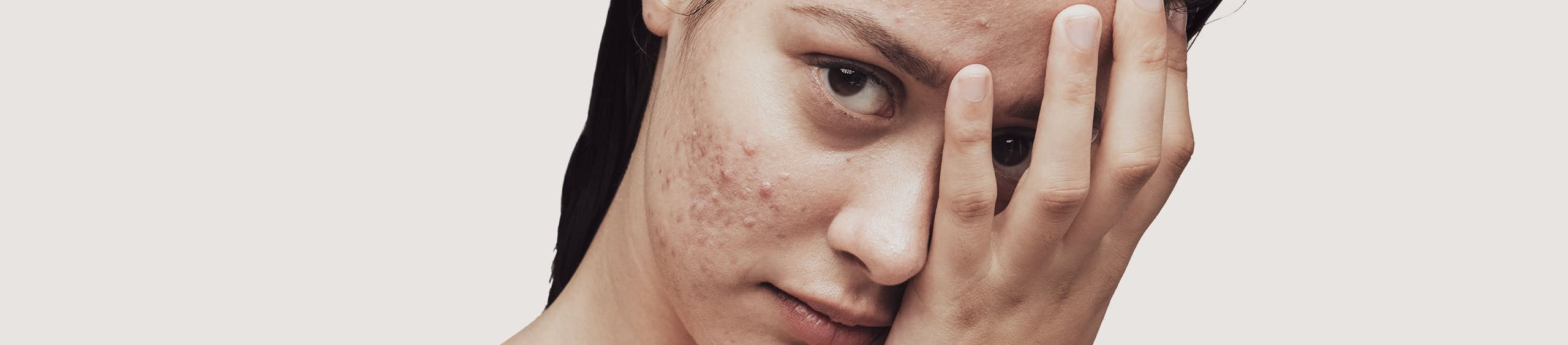 Chica adulta con acné en la cara