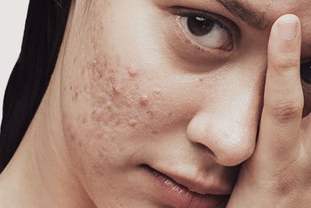 Chica adulta con acné en la cara