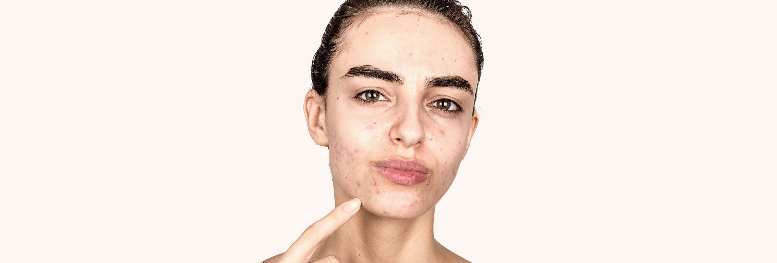 Persona con acné en el rostro