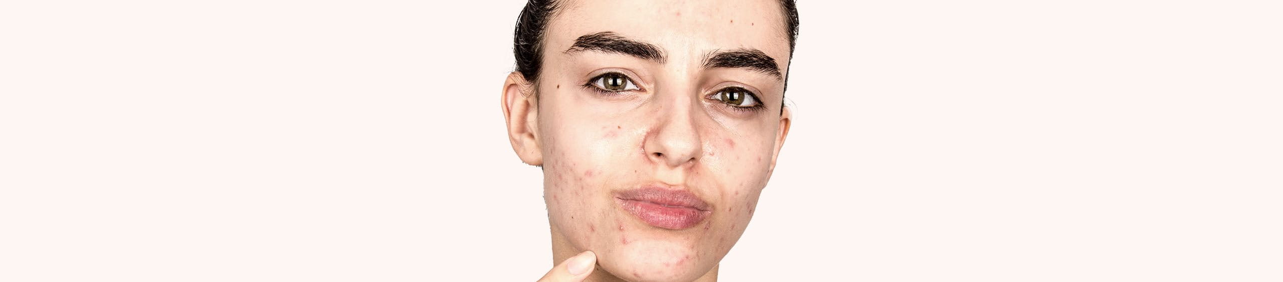 Persona con acné en el rostro