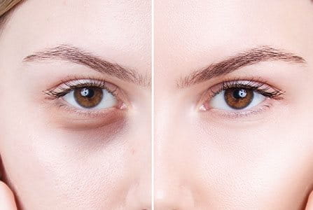 Mujer con ojeras y bolsas en los ojos