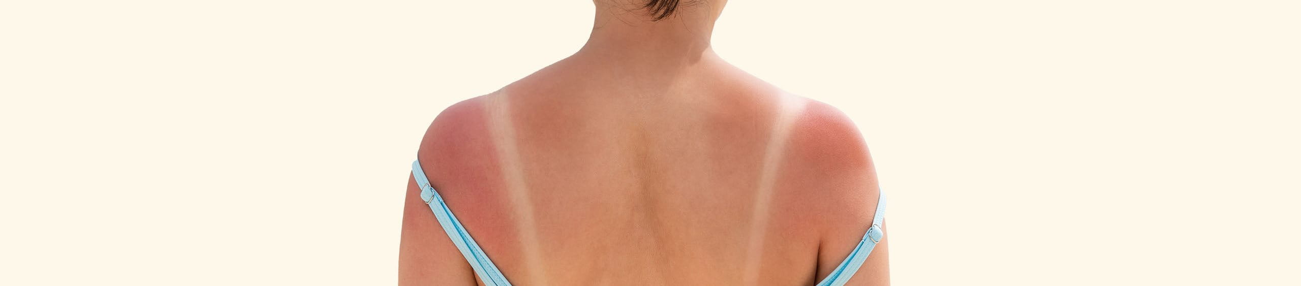 Persona afectada por el sol