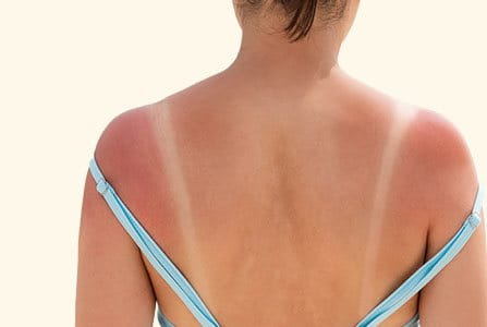 Persona afectada por el sol