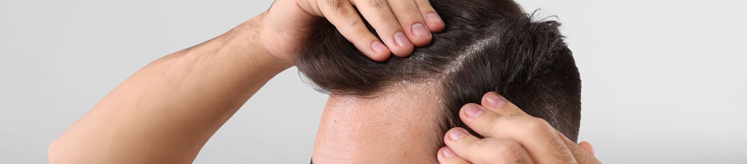 Persona con dermatitis seborreica