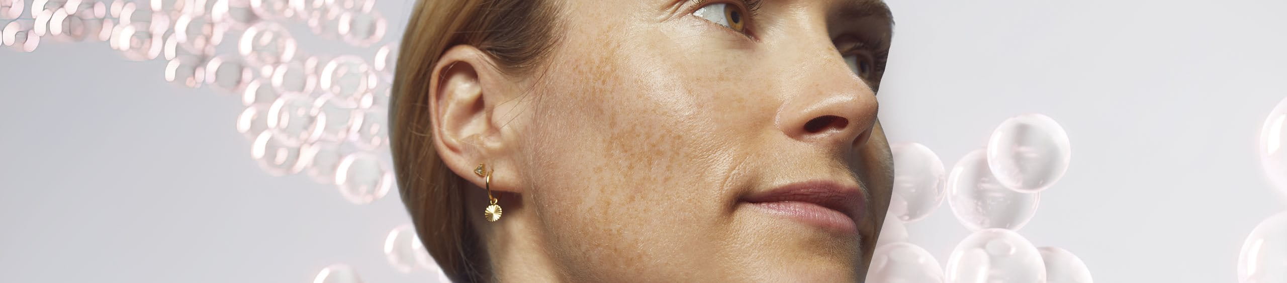 Hiperpigmentación de la piel