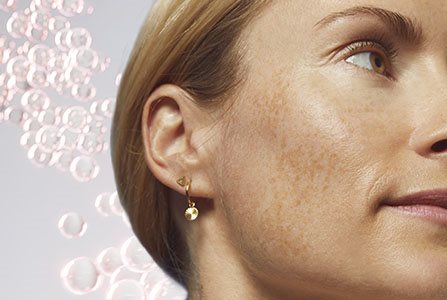 Hiperpigmentación de la piel