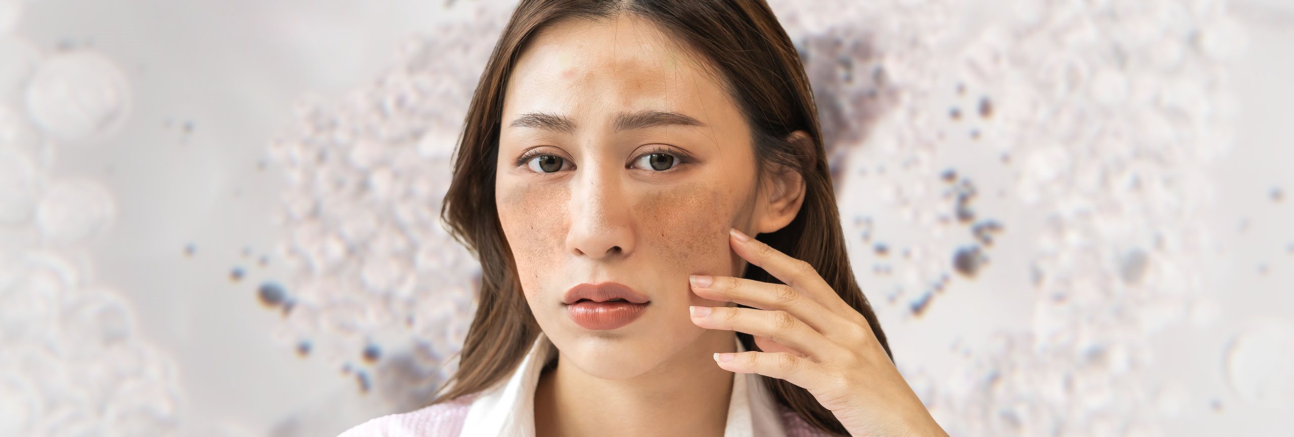 Hiperpigmentación por melasma