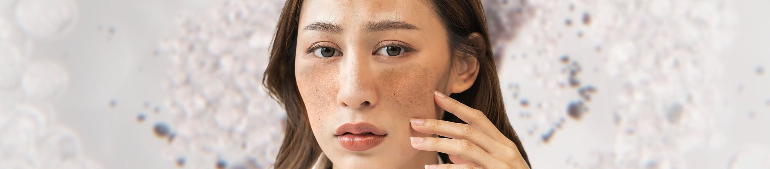 Hiperpigmentación por melasma