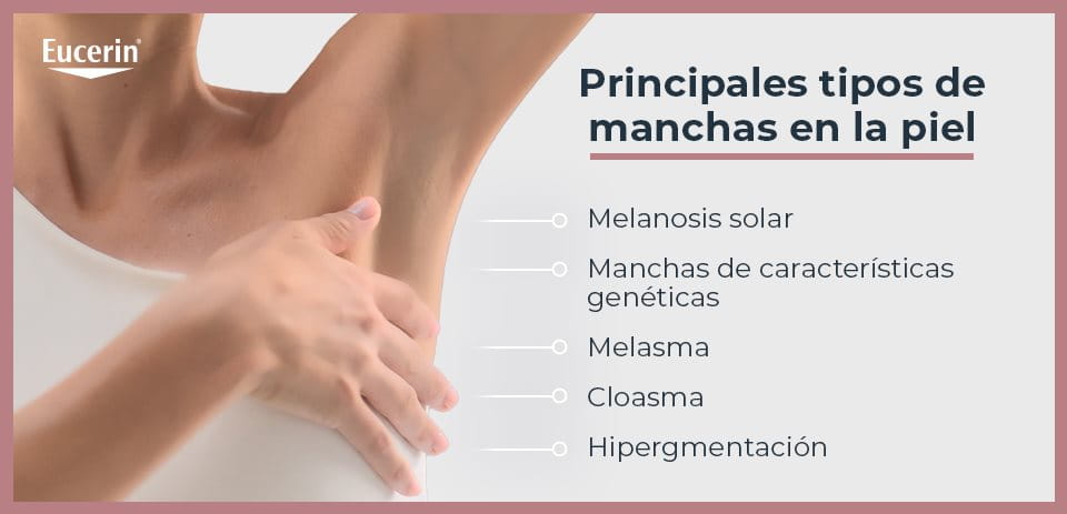 Tipos de manchas en la piel