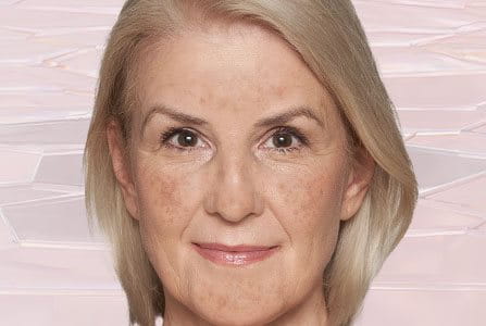 Manchas en la piel causadas por la edad