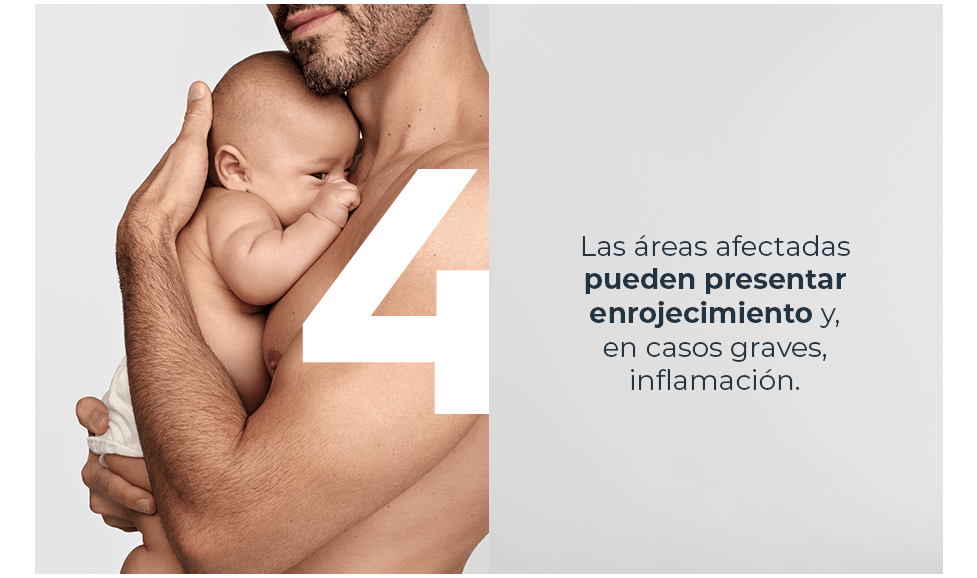Áreas afectadas pueden presentar enrojecimiento
