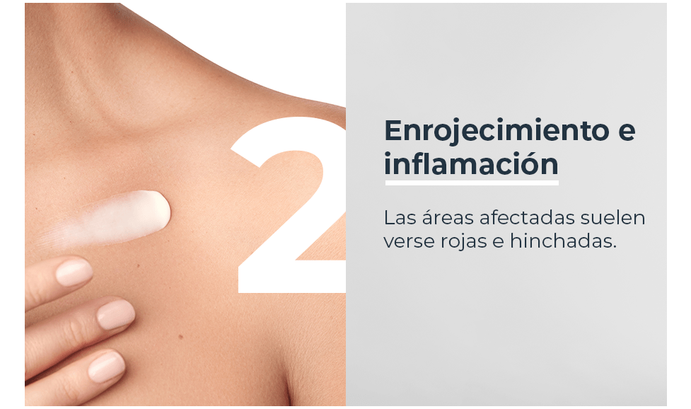 Enrojecimiento e inflamación