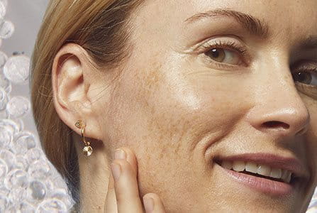 Prevenir la hiperpigmentación facial