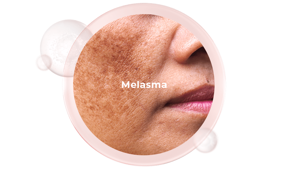 Melasma