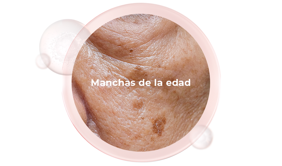 Manchas de la edad