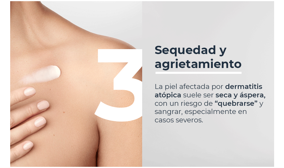 Sequedad y agrietamiento