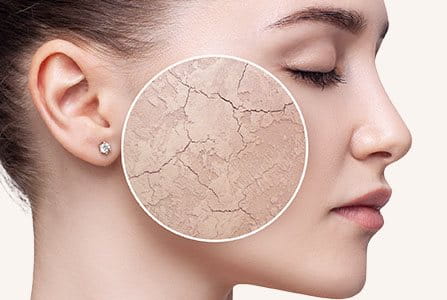 Persona con piel seca