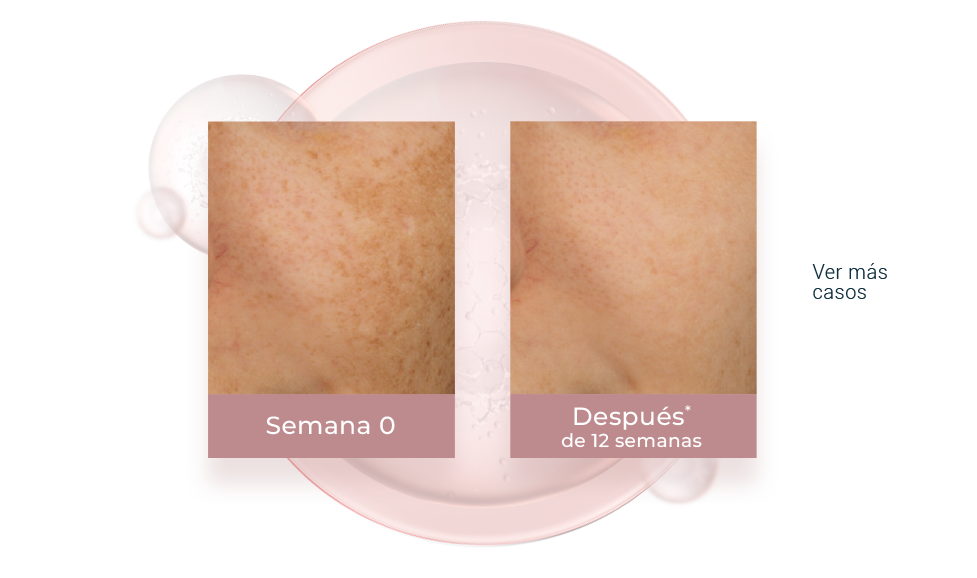 Resultados del thiamidol contra las manchas del rostro.