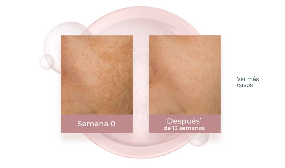 Resultados del thiamidol contra las manchas del rostro.