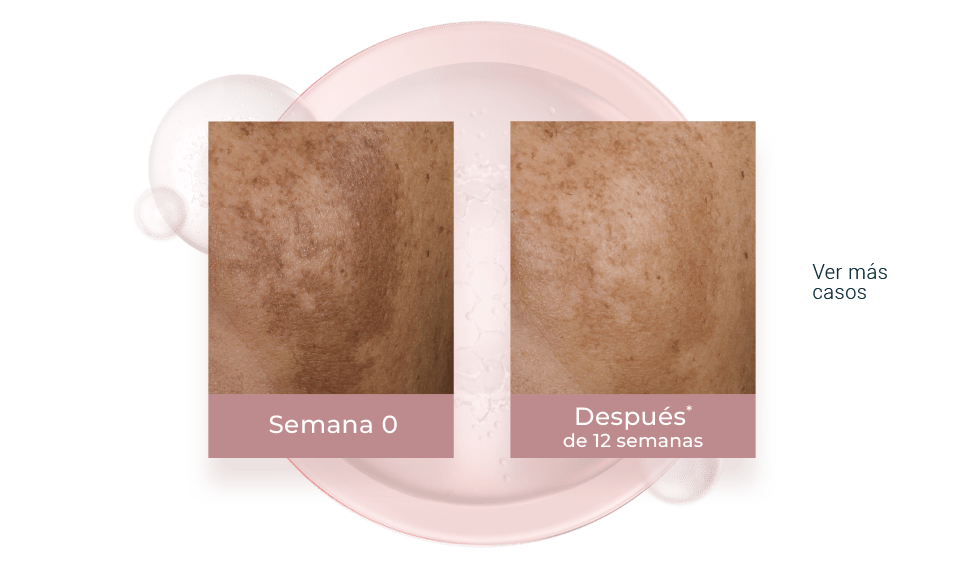 Resultados del thiamidol contra las manchas del rostro.