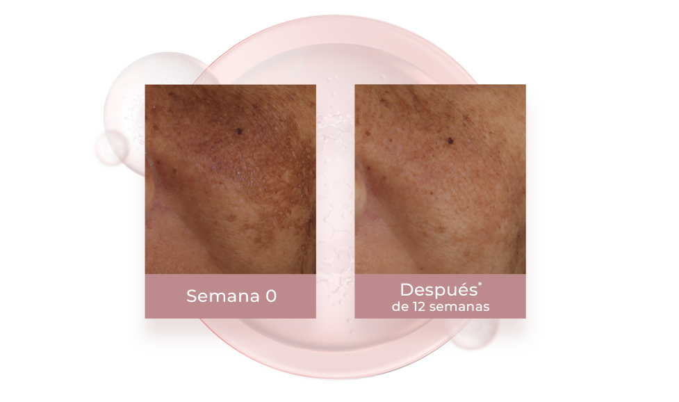 Resultados del thiamidol contra las manchas del rostro.