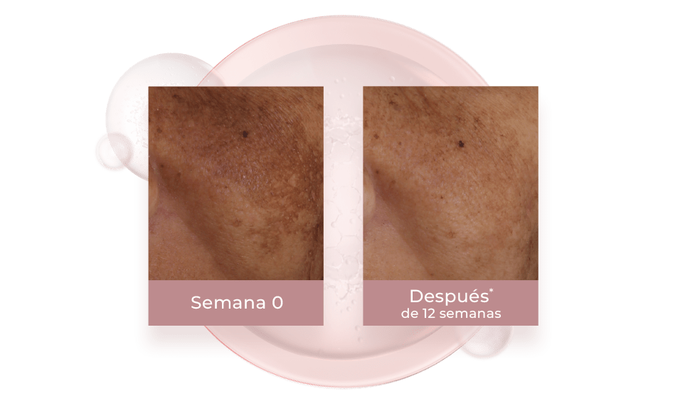 Resultados del thiamidol contra las manchas del rostro.