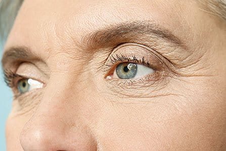 Líneas de expresión en los ojos