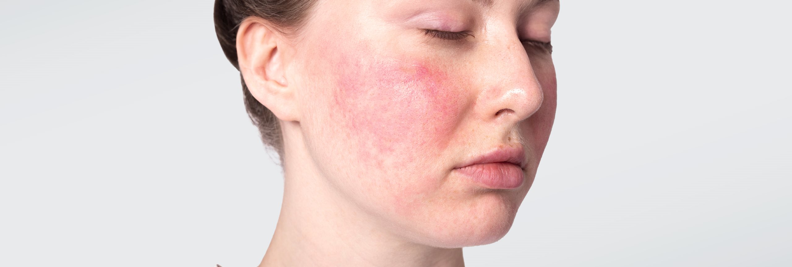 Dermatitis atópica en la cara