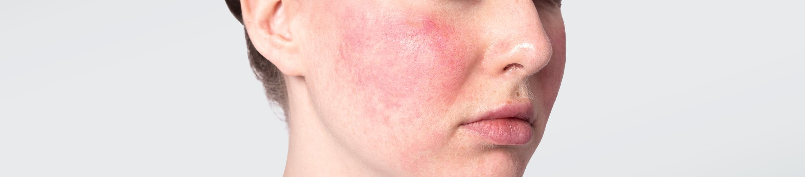 Dermatitis atópica en la cara