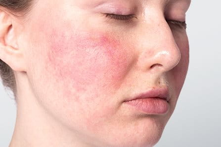 Dermatitis atópica en la cara