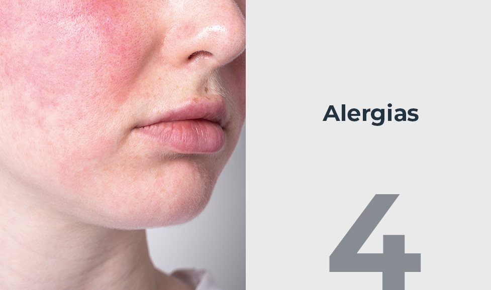 Alergias