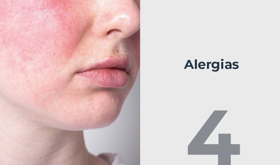 Alergias