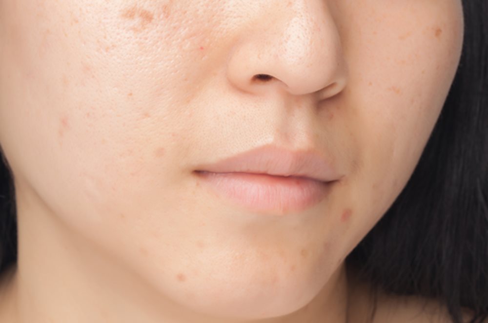 asian woman acne