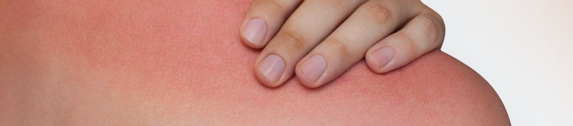 hand op verbrande schouder